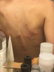 Piqures dans le dos avec réaction allergique