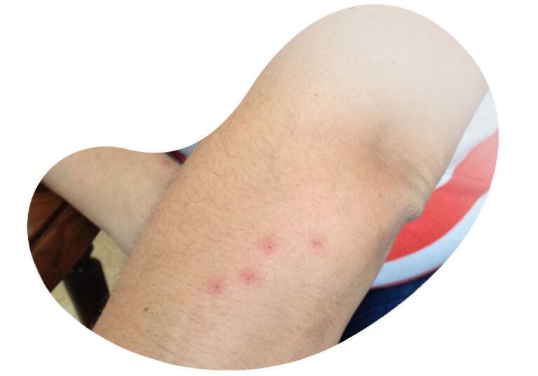Tout savoir sur la piqure de punaise de lit. Dogscan vous explique tout